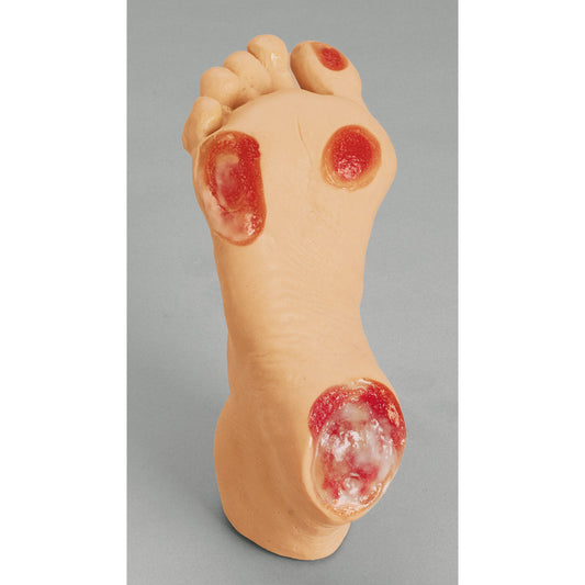 Elderly Pressure Ulcer Foot - Erler Zimmer