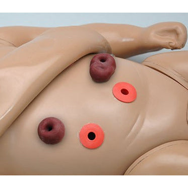 Stoma sites with reservoirs for R17700 - Erler Zimmer