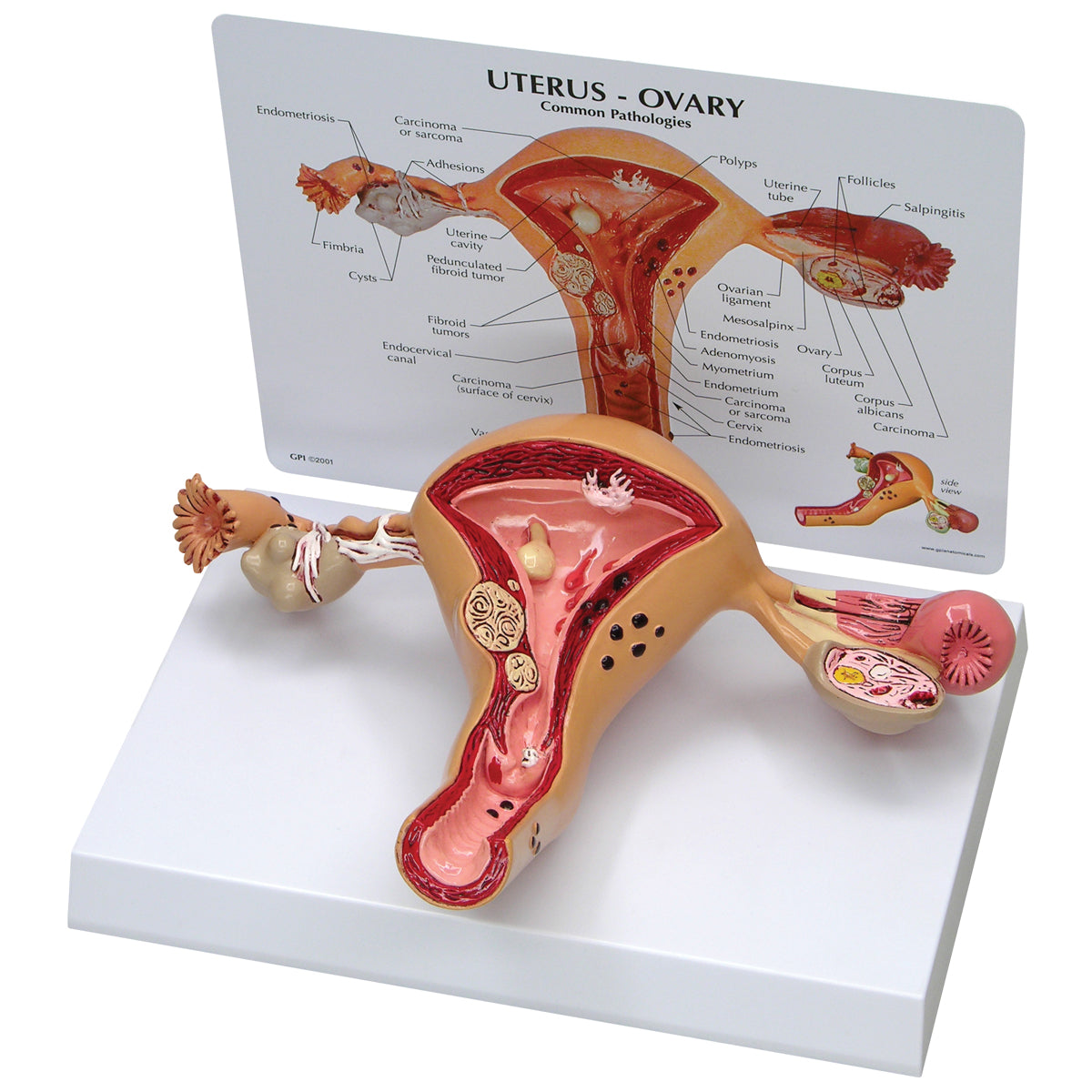 Uterus-Ovary Model - 3B Scientific