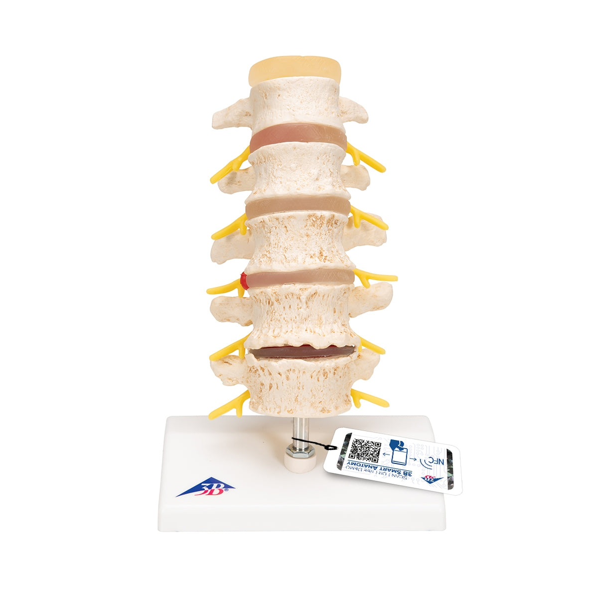 Stages of Disc Prolapse and Vertebral Degeneration - 3B Scientific
