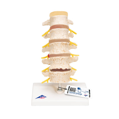 Stages of Disc Prolapse and Vertebral Degeneration - 3B Scientific