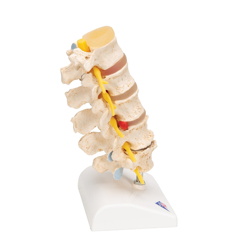 Stages of Disc Prolapse and Vertebral Degeneration – Medisave UK