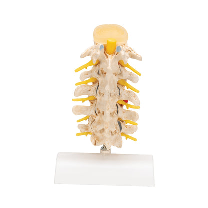 Stages of Disc Prolapse and Vertebral Degeneration - 3B Scientific