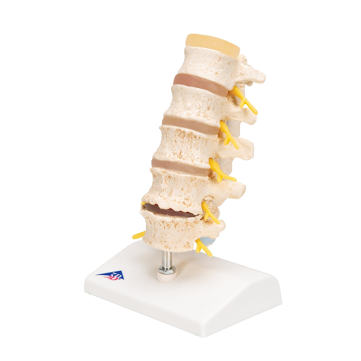 Stages of Disc Prolapse and Vertebral Degeneration - 3B Scientific