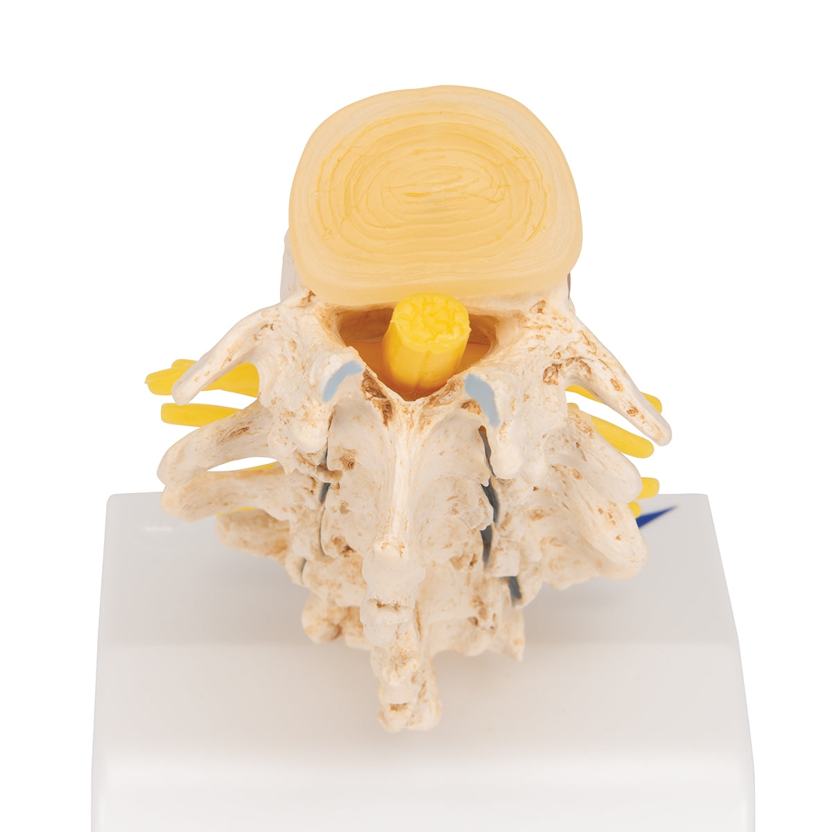 Stages of Disc Prolapse and Vertebral Degeneration - 3B Scientific