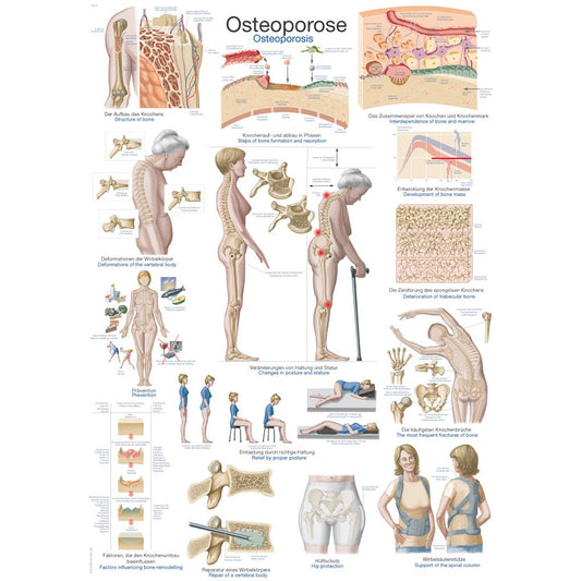 Osteoporosis - Poster