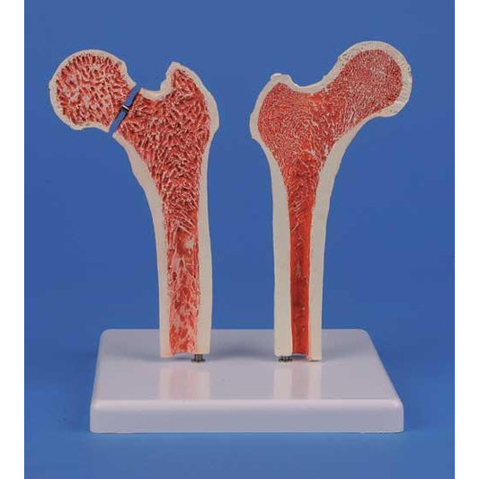 Osteoporosis Femur