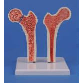 Osteoporosis Femur