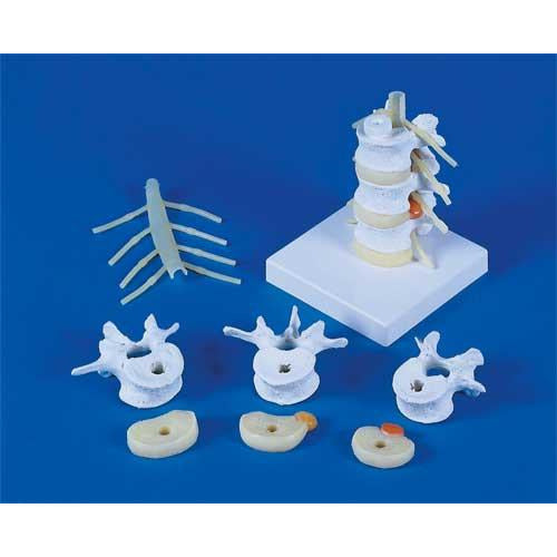 Lumbar Vertebrae With Prolapsed Intervertebral Discs