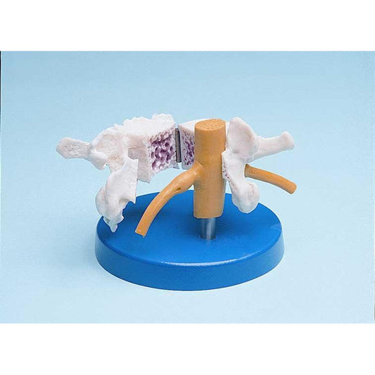 Folding Osteoporosis Model