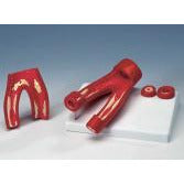 Arteriosclerosis Model