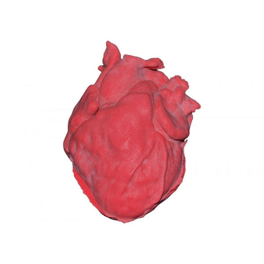 Pediatric Heart with Ventricular Septal Defect (VSD) - Erler Zimmer