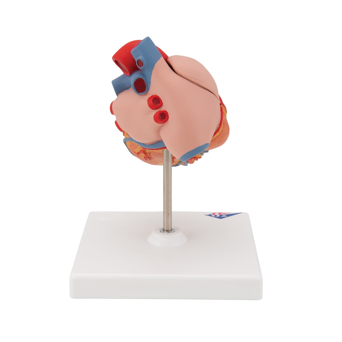 Classic Human Heart Model with Left Ventricular Hypertrophy (LVH), 2 part
