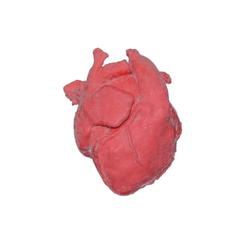Pediatric Heart with Corrected Transposition of Great Arteries & Ventricular Septal Defect (VSD)