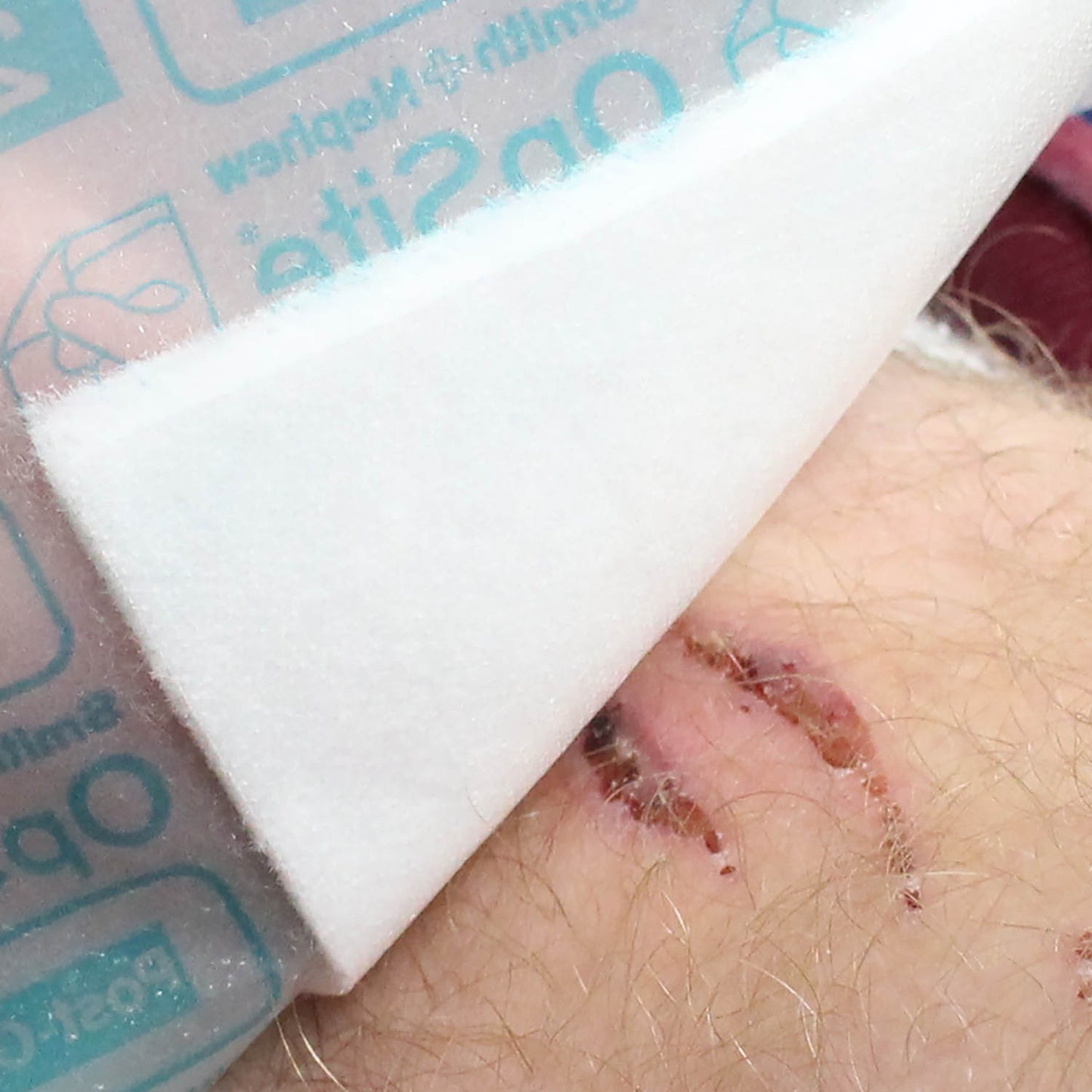 OPSITE Post-Op Dressing 35 x 10cm - Pack of 20 - Smith & Nephew