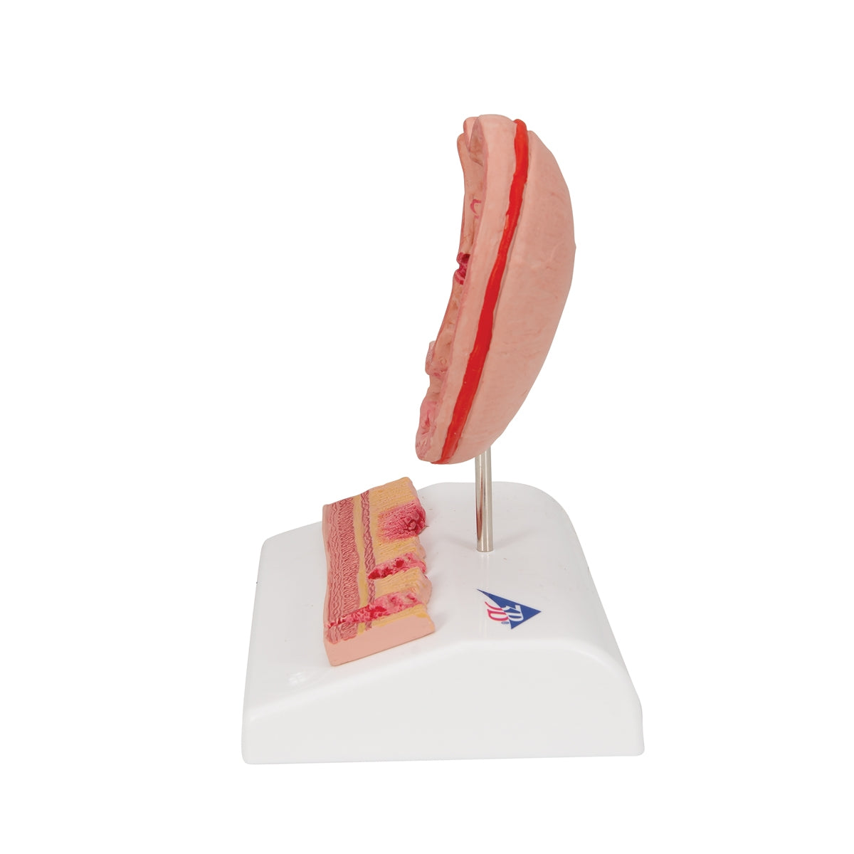 Human Stomach Section Model with Ulcers