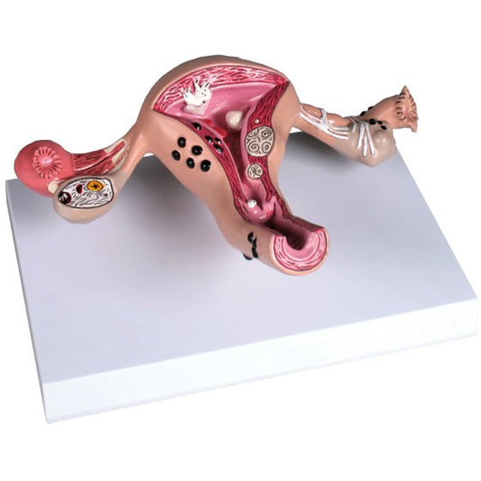 Erler Zimmer Uterus Model with Diseases - 
