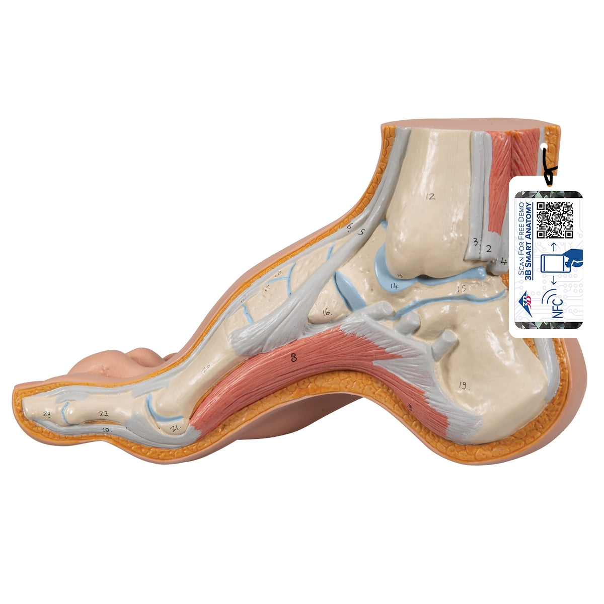 Hollow Foot (Pes Cavus) Model - 3B Scientific