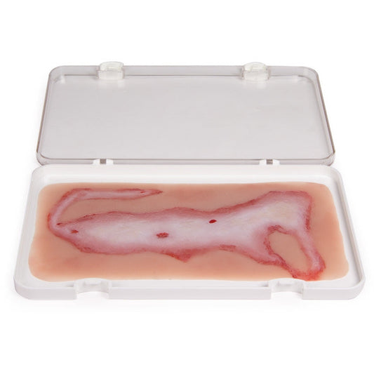Wound Moulage Scalding - Large - Erler Zimmer