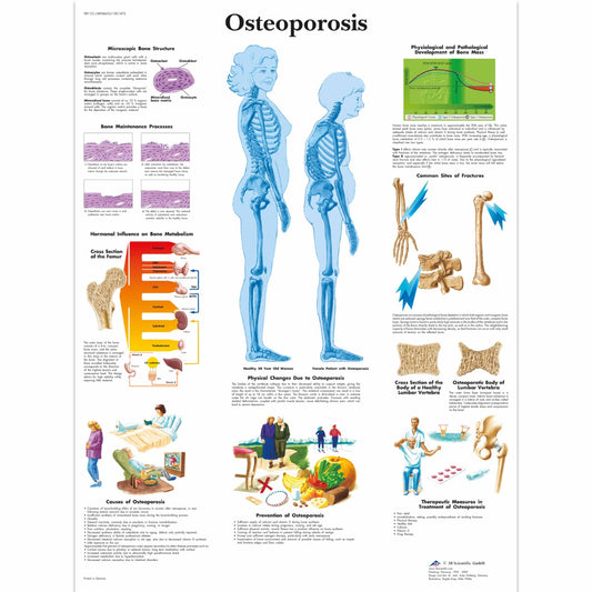 Osteoporosis Chart - 3B Scientific