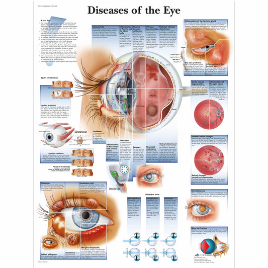 Diseases of the Eye Chart - 3B Scientific