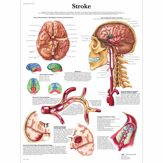 Stroke Chart - 3B Scientific