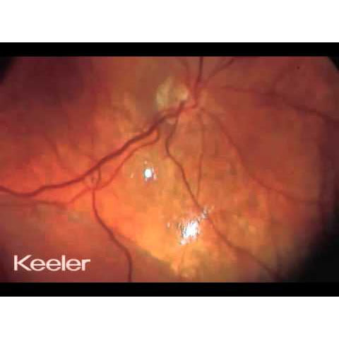 Keeler Vantage Plus Indirect LED Binocular Ophthalmoscope